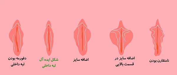 انواع شکل بیرونی دستگاه تناسلی